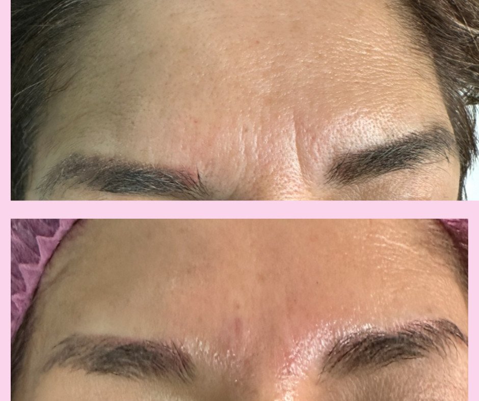 Facial fillers