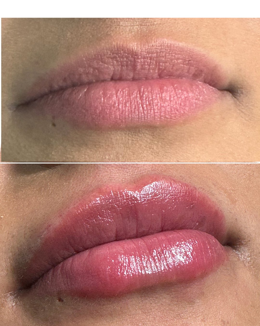 Lips Filler