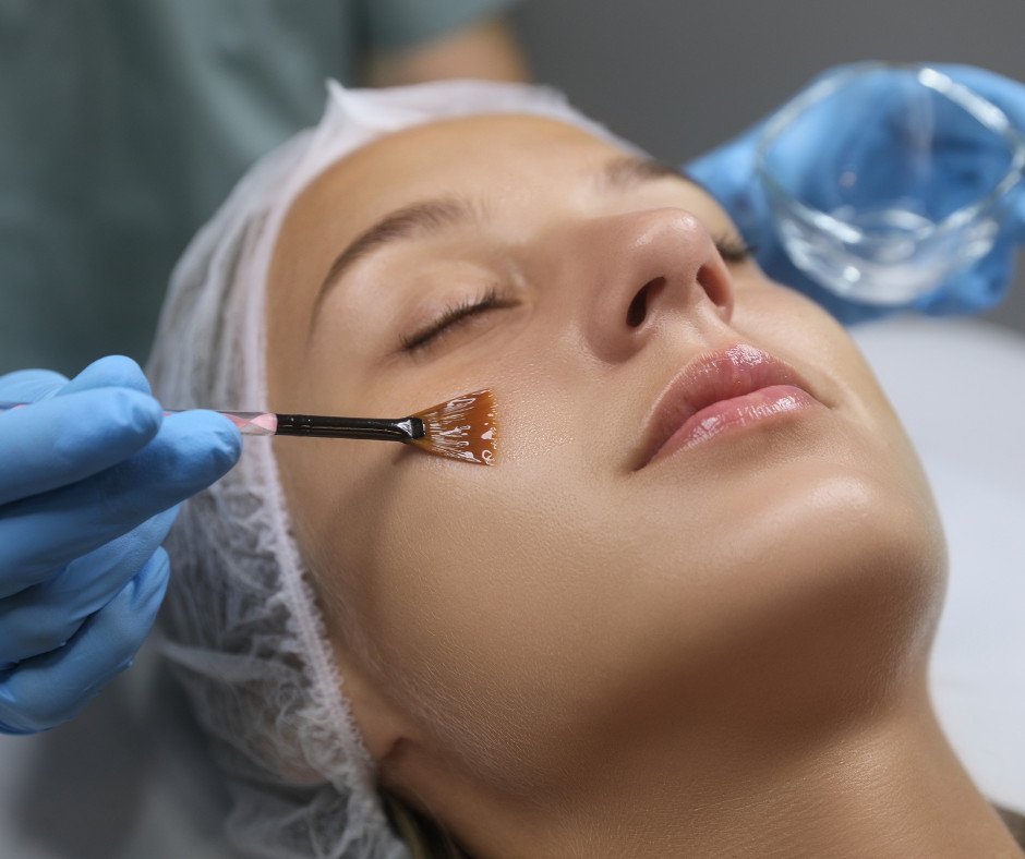 Chemical Peel