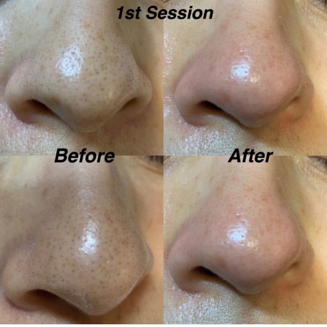 Blackhead cleansing