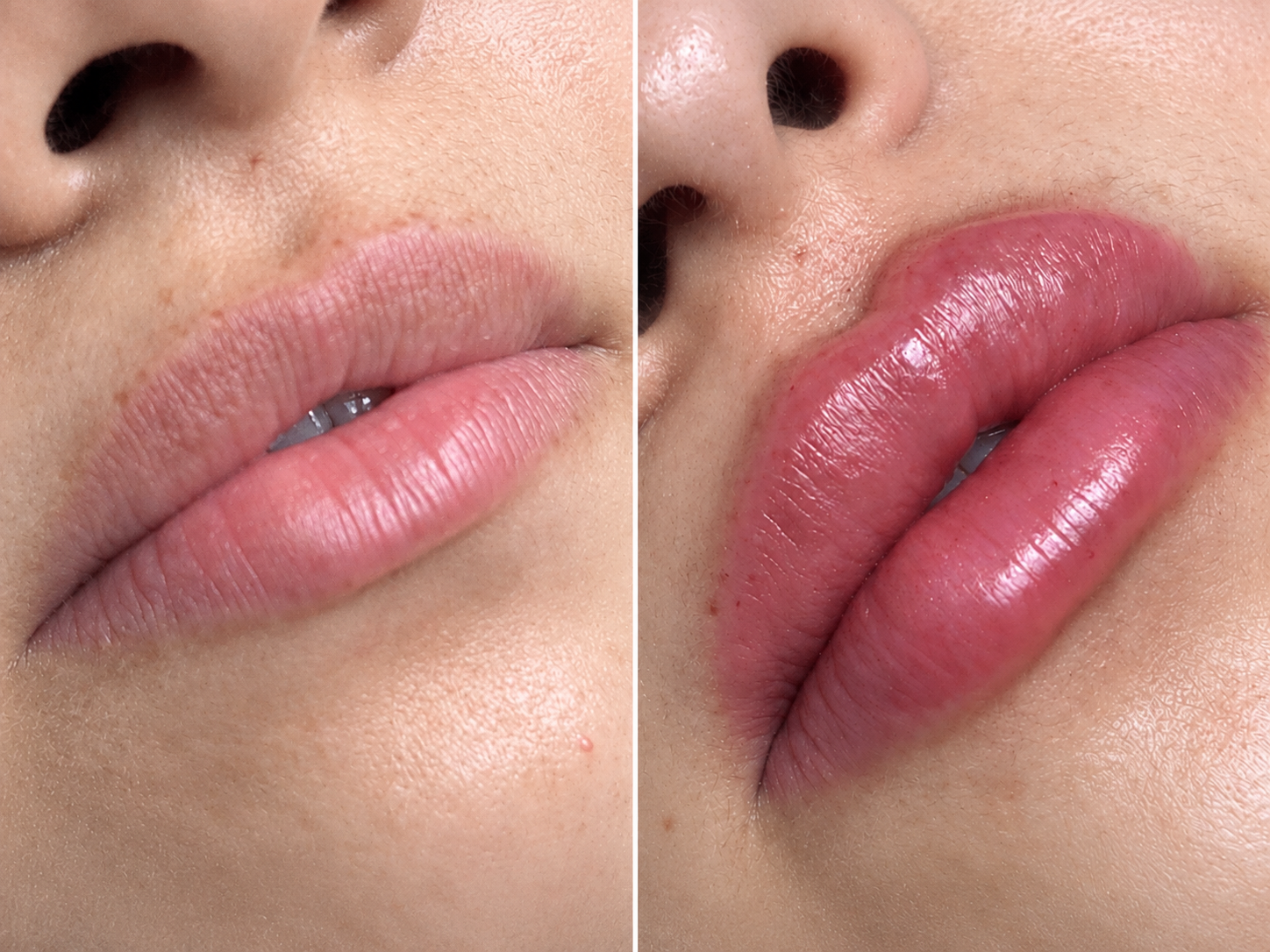 Lip Filler